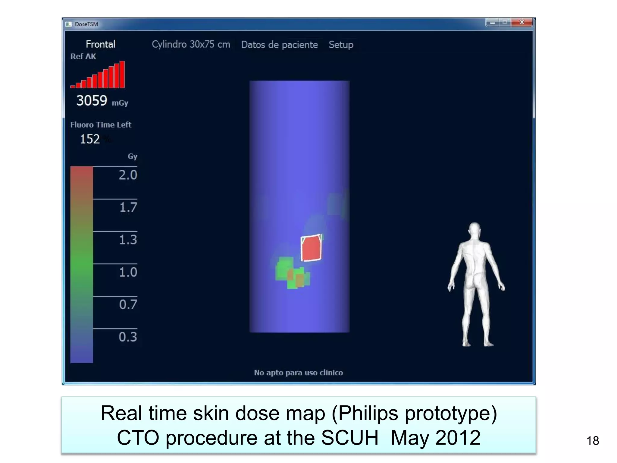Real time skin dose map (Philips prototype)
CTO procedure at the SCUH May 2012 18
 