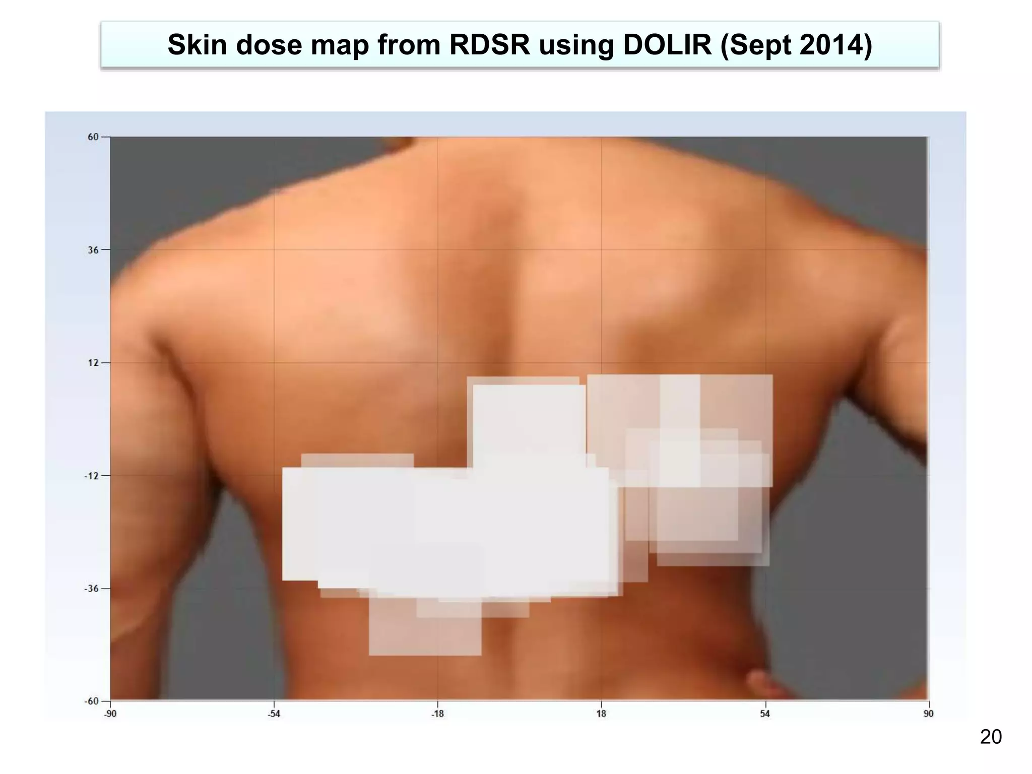 20
Skin dose map from RDSR using DOLIR (Sept 2014)
 