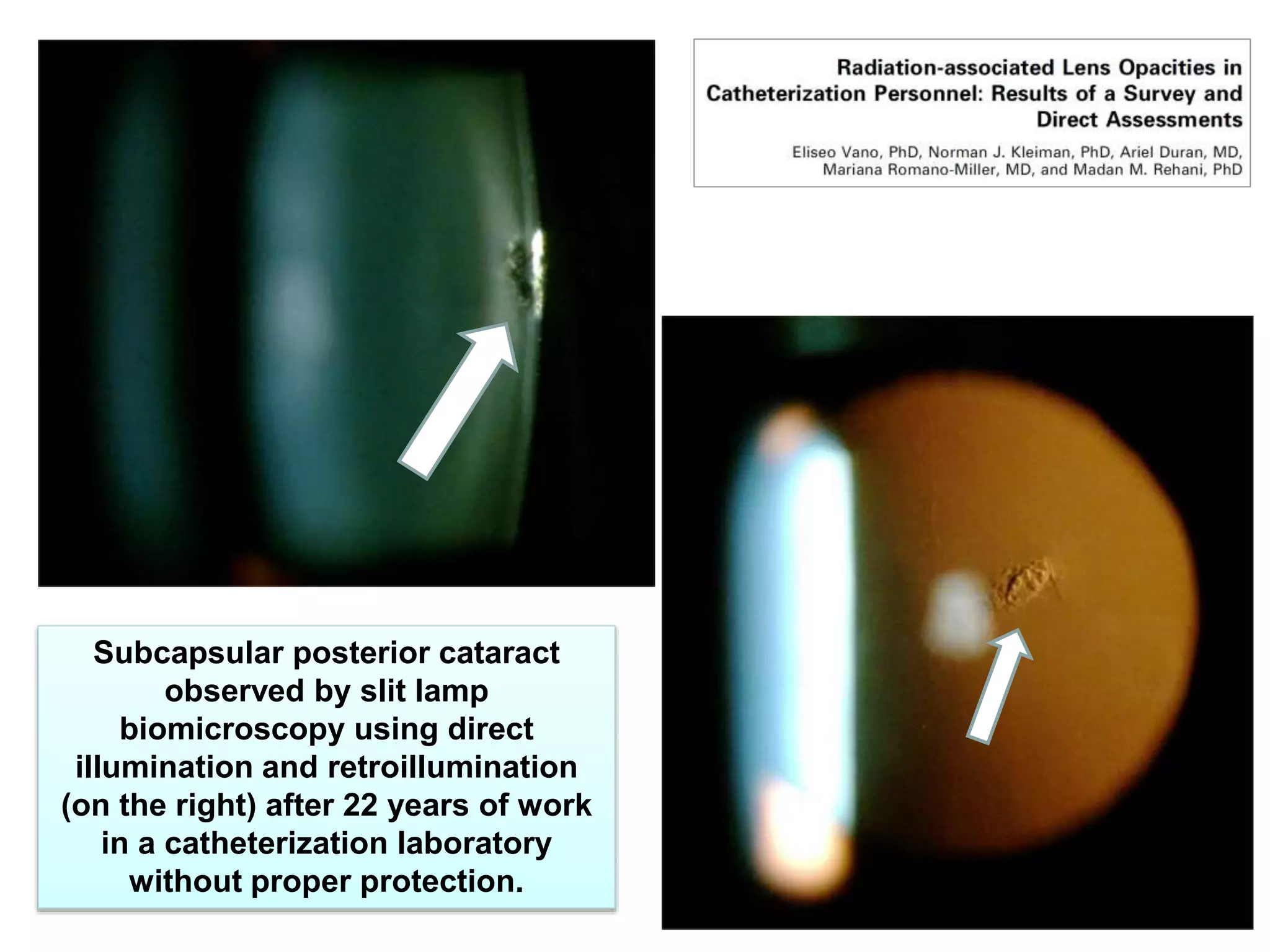 23
Subcapsular posterior cataract
observed by slit lamp
biomicroscopy using direct
illumination and retroillumination
(on the right) after 22 years of work
in a catheterization laboratory
without proper protection.
 