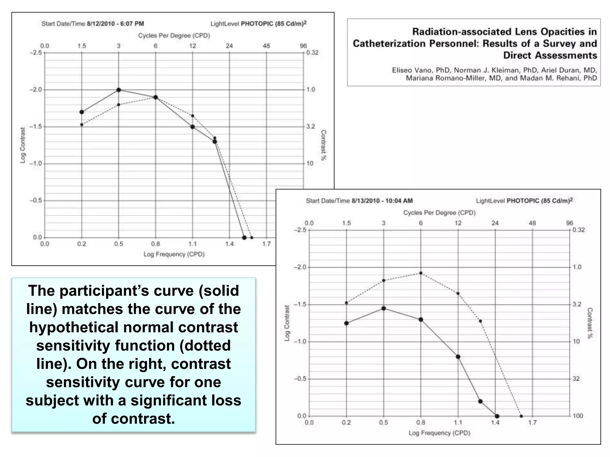 24
The participant’s curve (solid
line) matches the curve of the
hypothetical normal contrast
sensitivity function (dotted
line). On the right, contrast
sensitivity curve for one
subject with a significant loss
of contrast.
 
