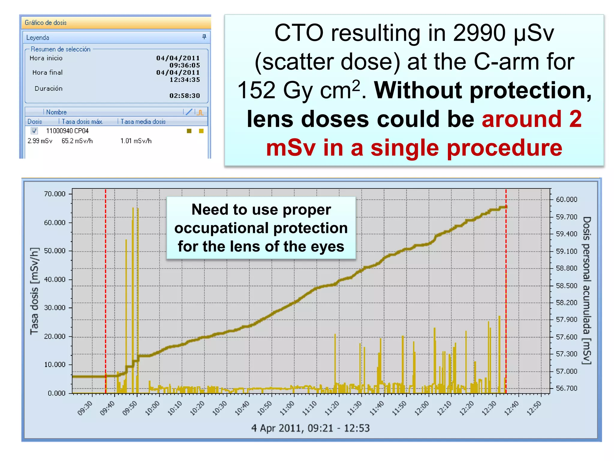 CTO resulting in 2990 μSv
(scatter dose) at the C-arm for
152 Gy cm2. Without protection,
lens doses could be around 2
mSv in a single procedure
Need to use proper
occupational protection
for the lens of the eyes
 