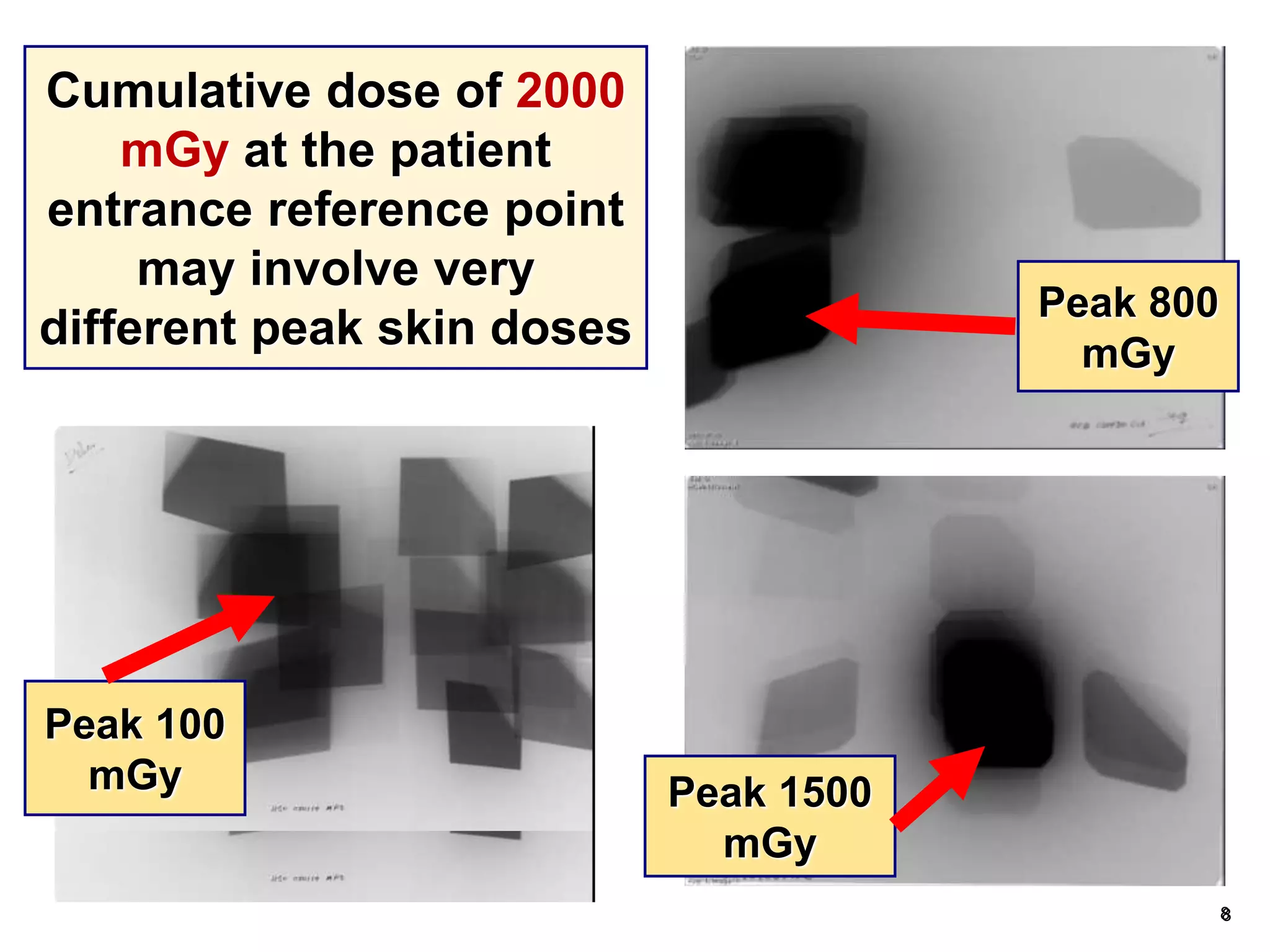 88
Cumulative dose of 2000
mGy at the patient
entrance reference point
may involve very
different peak skin doses
Peak 100
mGy Peak 1500
mGy
Peak 800
mGy
 