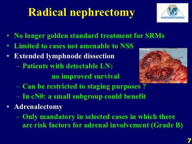 H. Van Poppel Kidney cancer Surgery (including nephronsparing su…