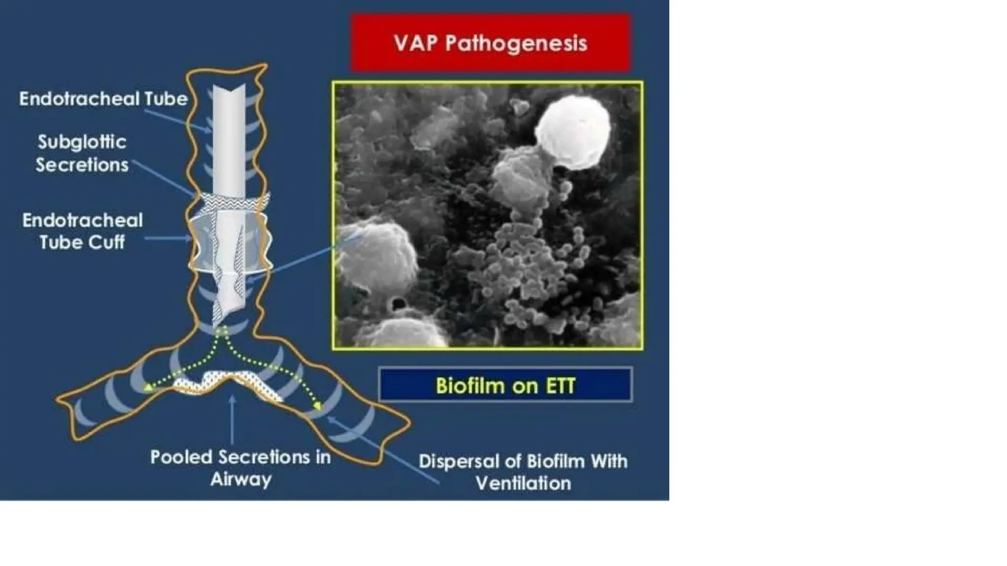 V.A.P. --Ventilator associated Pneumonia | PPTX