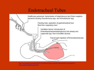 Endotracheal Tubes 