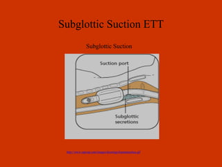 Subglottic Suction ETT Subglottic Suction 