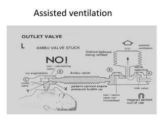 Assisted ventilation
 