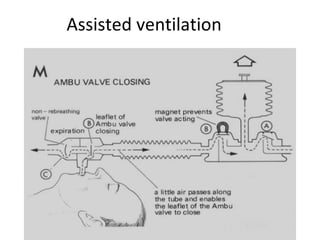 Assisted ventilation
 