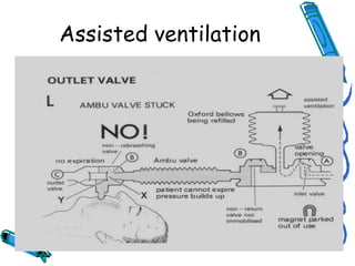 Assisted ventilation
 