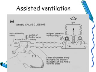 Assisted ventilation
 