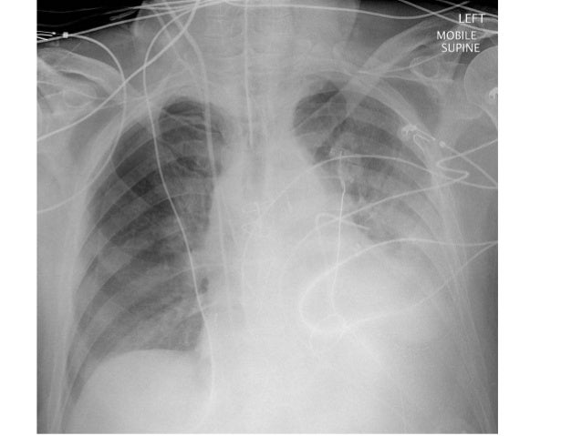 Ventilator associated pneumonia