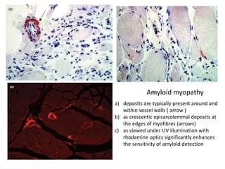 a) deposits are typically present around and
within vessel walls ( arrow )
b) as crescentic episarcolemmal deposits at
the edges of myofibres (arrows)
c) as viewed under UV illumination with
rhodamine optics significantly enhances
the sensitivity of amyloid detection
Amyloid myopathy
 