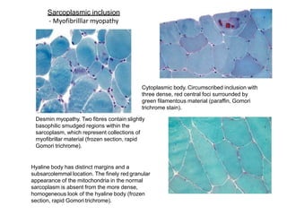 Sarcoplasmic inclusion
- Myofibrilllar myopathy
Cytoplasmic body. Circumscribed inclusion with
three dense, red central foci surrounded by
green filamentous material (paraffin, Gomori
trichrome stain).
Desmin myopathy. Two fibres contain slightly
basophilic smudged regions within the
sarcoplasm, which represent collections of
myofibrillar material (frozen section, rapid
Gomori trichrome).
Hyaline body has distinct margins and a
subsarcolemmal location. The finely red granular
appearance of the mitochondria in the normal
sarcoplasm is absent from the more dense,
homogeneous look of the hyaline body (frozen
section, rapid Gomori trichrome).
 