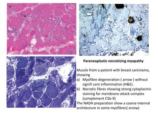 Paraneoplastic necrotizing myopathy
Muscle from a patient with breast carcinoma,
showing
a) Myofibre degeneration ( arrow ) without
signifi cant inflammation (H&E).
b) Necrotic fibres showing strong cytoplasmic
staining for membrane attack complex
(complement C5b-9)
The NADH preparation show a coarse internal
architecture in some myofibres( arrow)
 