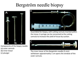 Bergström needle biopsy
Components of the biopsy needle:
(a) outer cannula
(b) inner trocar
(c) plunger
Assembled for biopsy, with cutting cannula inserted within
the trocar. A syringe can be connected to the cutting
cannula to increase the yield of tissue by suction.
The inner trocar of the Bergström needle (5 mm)
withdrawn approximately 1 cm opens the window of the
outer cannula.
 