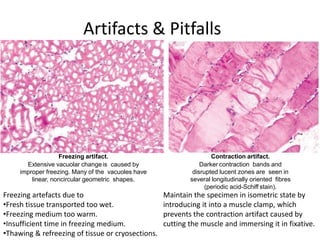 Artifacts & Pitfalls
Freezing artifact.
Extensive vacuolar change is caused by
improper freezing. Many of the vacuoles have
linear, noncircular geometric shapes.
Contraction artifact.
Darker contraction bands and
disrupted lucent zones are seen in
several longitudinally oriented fibres
(periodic acid-Schiff stain).
Freezing artefacts due to
•Fresh tissue transported too wet.
•Freezing medium too warm.
•Insufficient time in freezing medium.
•Thawing & refreezing of tissue or cryosections.
Maintain the specimen in isometric state by
introducing it into a muscle clamp, which
prevents the contraction artifact caused by
cutting the muscle and immersing it in fixative.
 