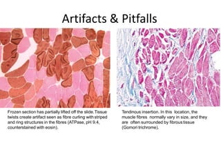 Frozen section has partially lifted off the slide.Tissue
twists create artifact seen as fibre curling withstriped
and ring structures in the fibres (ATPase, pH 9.4,
counterstained with eosin).
Tendinous insertion. In this location, the
muscle fibres normally vary in size, and they
are often surrounded by fibroustissue
(Gomori trichrome).
Artifacts & Pitfalls
 