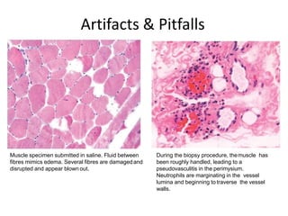 Muscle specimen submitted in saline. Fluid between
fibres mimics edema. Several fibres are damagedand
disrupted and appear blown out.
During the biopsy procedure, themuscle has
been roughly handled, leading to a
pseudovasculitis in the perimysium.
Neutrophils are marginating in the vessel
lumina and beginning to traverse the vessel
walls.
Artifacts & Pitfalls
 