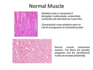 Normal muscle (transverse
section). The fibers are typically
polygonal, and the sarcolemmal
nuclei are located peripherally.
Skeletal mucle is composed of
elongated, multinucleate ,unbranched
contractile cell described as mucle fibre
Characteristic cross-striations seen on
LM d/t arrangement of contractile protein
Normal Muscle
 
