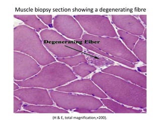 Muscle biopsy section showing a degenerating fibre
(H & E, total magnification,×200).
 