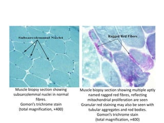 Muscle biopsy section showing
subsarcolemmal nuclei in normal
fibres.
Gomori’s trichrome stain
(total magnification, ×400)
Muscle biopsy section showing multiple aptly
named ragged red fibres, reflecting
mitochondrial proliferation are seen
Granular red staining may also be seen with
tubular aggregates and rod bodies.
Gomori’s trichrome stain
(total magnification, ×400)
 
