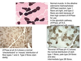 Normal muscle. In the alkaline
adenosine triphosphatase
(ATPase) reaction, type 1
fibers are light, and type 2
fibers are dark because of
their high content of ATPase
for use
in the glycolytic pathway.
(ATPase, pH 9.4,
counterstained with eosin).
‘Reverse’ ATPase ph 4.3 shows
the normal distribution of dark
type 1 fibres, pale type 2A fibres
and also
intermediate type 2B fibres.
ATPase at ph 9.4 shows a normal
‘checkerboard’ or ‘mosaic’ distribution of
fibre types 1 and 2. Type 2 fibres stain
darkly.
 