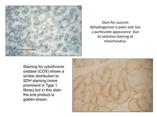 Stain for succinic
dehydrogenase is paler and has
a particulate appearance due
to selective staining of
mitochondria.
Staining for cytochrome
oxidase (COX) shows a
similar distribution to
SDH staining (more
prominent in Type 1
fibres) but in this stain
the end product is
golden brown.
 