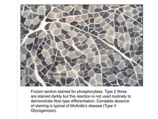 Frozen section stained for phosphorylase. Type 2 fibres
are stained darkly but this reaction is not used routinely to
demonstrate fibre type differentiation. Complete absence
of staining is typical of McArdle’s disease (Type V
Glycogenosis).
 