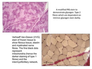 A modified PAS stain to
demonstrate glycogen. Type 2
fibres which are dependent on
intrinsic glycogen stain darkly.
Verhoeff Van-Gieson (VVG)
stain of frozen tissue to
show fibrous tissue, elastin
and myelinated nerve
fibres. The fine black dots
represent
mitochondria (hence the
darker staining of type 1
fibres) and the
intermyofibrillary network.
 