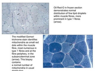 Oil Red-O in frozen section
demonstrates normal
distribution of fine lipid droplets
within muscle fibres, more
prominent in type 1 fibres
(arrow).
The modified Gomori
trichrome stain identifies
mitochondria as small red
dots within the muscle
fibre, most numerous in
type 1 fibres and at the
fibre periphery, in the
subsarcolemmal zone
(arrow). This biopsy
contains
a normal number of
mitochondria in usual
 