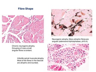 Neurogenic atrophy. Many atrophic fibresare
angular (adenosine triphosphatase, pH 9.4).
Chronic neurogenic atrophy.
Grouping of many small
angular fibres is evident.
Infantile spinal muscularatrophy.
Most of the fibres in the fascicle
are atrophic and rounded.
Fibre Shape
 