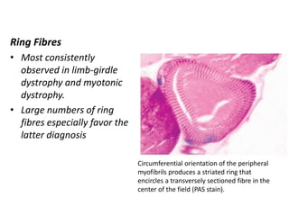 Ring Fibres
• Most consistently
observed in limb-girdle
dystrophy and myotonic
dystrophy.
• Large numbers of ring
fibres especially favor the
latter diagnosis
Circumferential orientation of the peripheral
myofibrils produces a striated ring that
encircles a transversely sectioned fibre in the
center of the field (PAS stain).
 