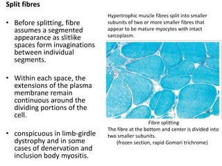 Split fibres
• Before splitting, fibre
assumes a segmented
appearance as slitlike
spaces form invaginations
between individual
segments.
• Within each space, the
extensions of the plasma
membrane remain
continuous around the
dividing portions of the
cell.
• conspicuous in limb-girdle
dystrophy and in some
cases of denervation and
inclusion body myositis.
Fibre splitting
The fibre at the bottom and center is divided into
two smaller subunits.
(frozen section, rapid Gomori trichrome)
Hypertrophic muscle fibres split into smaller
subunits of two or more smaller fibres that
appear to be mature myocytes with intact
sarcoplasm.
 