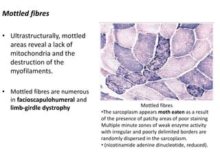 Mottled fibres
• Ultrastructurally, mottled
areas reveal a lack of
mitochondria and the
destruction of the
myofilaments.
• Mottled fibres are numerous
in facioscapulohumeral and
limb-girdle dystrophy Mottled fibres
•The sarcoplasm appears moth eaten as a result
of the presence of patchy areas of poor staining
Multiple minute zones of weak enzyme activity
with irregular and poorly delimited borders are
randomly dispersed in the sarcoplasm.
• (nicotinamide adenine dinucleotide, reduced).
 
