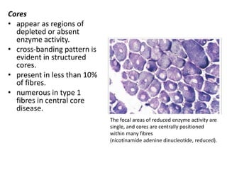 Cores
• appear as regions of
depleted or absent
enzyme activity.
• cross-banding pattern is
evident in structured
cores.
• present in less than 10%
of fibres.
• numerous in type 1
fibres in central core
disease.
The focal areas of reduced enzyme activity are
single, and cores are centrally positioned
within many fibres
(nicotinamide adenine dinucleotide, reduced).
 
