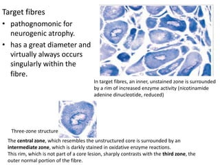 Target fibres
• pathognomonic for
neurogenic atrophy.
• has a great diameter and
virtually always occurs
singularly within the
fibre.
In target fibres, an inner, unstained zone is surrounded
by a rim of increased enzyme activity (nicotinamide
adenine dinucleotide, reduced)
The central zone, which resembles the unstructured core is surrounded by an
intermediate zone, which is darkly stained in oxidative enzyme reactions.
This rim, which is not part of a core lesion, sharply contrasts with the third zone, the
outer normal portion of the fibre.
Three-zone structure
 