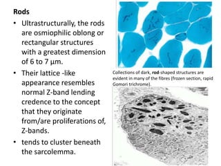 Rods
• Ultrastructurally, the rods
are osmiophilic oblong or
rectangular structures
with a greatest dimension
of 6 to 7 μm.
• Their lattice -like
appearance resembles
normal Z-band lending
credence to the concept
that they originate
from/are proliferations of,
Z-bands.
• tends to cluster beneath
the sarcolemma.
Collections of dark, rod-shaped structures are
evident in many of the fibres (frozen section, rapid
Gomori trichrome).
 