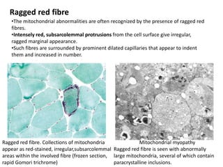 Mitochondrial myopathy
Ragged red fibre is seen with abnormally
large mitochondria, several of which contain
paracrystalline inclusions.
Ragged red fibre. Collections of mitochondria
appear as red-stained, irregular,subsarcolemmal
areas within the involved fibre (frozen section,
rapid Gomori trichrome)
Ragged red fibre
•The mitochondrial abnormalities are often recognized by the presence of ragged red
fibres.
•Intensely red, subsarcolemmal protrusions from the cell surface give irregular,
ragged marginal appearance.
•Such fibres are surrounded by prominent dilated capillaries that appear to indent
them and increased in number.
 