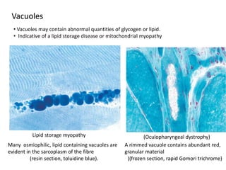 Many osmiophilic, lipid containing vacuoles are
evident in the sarcoplasm of the fibre
(resin section, toluidine blue).
Vacuoles
A rimmed vacuole contains abundant red,
granular material
((frozen section, rapid Gomori trichrome)
• Vacuoles may contain abnormal quantities of glycogen or lipid.
• Indicative of a lipid storage disease or mitochondrial myopathy
Lipid storage myopathy (Oculopharyngeal dystrophy)
 