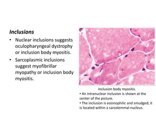 Inclusions
• Nuclear inclusions suggests
oculopharyngeal dystrophy
or inclusion body myositis.
• Sarcoplasmic inclusions
suggest myofibrillar
myopathy or inclusion body
myositis.
Inclusion body myositis.
• An intranuclear inclusion is shown at the
center of the picture.
• The inclusion is eosinophilic and smudged; it
is located within a sarcolemmal nucleus.
 