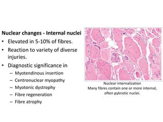 Nuclear changes - Internal nuclei
• Elevated in 5-10% of fibres.
• Reaction to variety of diverse
injuries.
• Diagnostic significance in
– Myotendinous insertion
– Centronuclear myopathy
– Myotonic dystrophy
– Fibre regeneration
– Fibre atrophy
Nuclear internalization
Many fibres contain one or more internal,
often pyknotic nuclei.
 