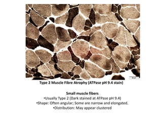 Type 2 Muscle Fibre Atrophy (ATPase pH 9.4 stain)
Small muscle fibers
•Usually Type 2 (Dark stained at ATPase pH 9.4)
•Shape: Often angular; Some are narrow and elongated.
•Distribution: May appear clustered
 