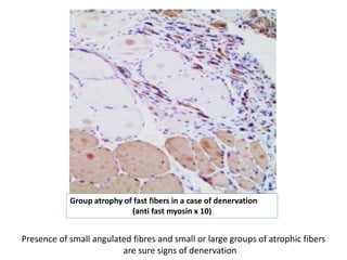 Presence of small angulated fibres and small or large groups of atrophic fibers
are sure signs of denervation
Group atrophy of fast fibers in a case of denervation
(anti fast myosin x 10)
 