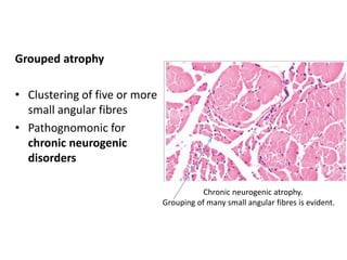 Grouped atrophy
• Clustering of five or more
small angular fibres
• Pathognomonic for
chronic neurogenic
disorders
Chronic neurogenic atrophy.
Grouping of many small angular fibres is evident.
 