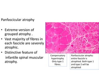Panfascicular atrophy
• Extreme version of
grouped atrophy .
• Vast majority of fibres in
each fascicle are severely
atrophic.
• Distinctive feature of
infantile spinal muscular
atrophy.
Panfascicular atrophy:
entire fascicle is
atrophied. Both type 1
and type 2 will be
atrophied
Compensatory
hypertrophy.
Only type 1
fibres.
 