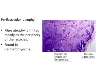 Perifascicular atrophy
• Fibre atrophy is limited
mainly to the periphery
of the fascicles.
• Found in
dermatomyositis.
fibres in the
middle stay
the same size
fibres on
edges shrink
 