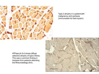 ATPase ph 9.4 shows diffuse
selective atrophy of type 2 fibres.
This was a common finding in
biopsies from patients attending
the Rheumatology clinic.
Type 2 atrophy in a patient with
malignancy and cachexia
(immunostain for fast myosin).
 