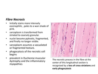 Fibre Necrosis
• Initially stains more intensely
eosinophilic , pales to a wan shade of
pink.
• sarcoplasm is transformed from
striated to coarsely granular.
• nuclei become pyknotic, fragmented,
and finally no longer visible.
• sarcoplasm assumes a vacuolated
or fragmented texture.
• phagocytosis of the necrotic cell
begins
• prevalent in Duchenne muscular
dystrophy and the inflammatory
myopathies
The necrotic process in the fibre at the
center of this longitudinal section is
recognized by a loss of cross striations and
early phagocytosis
 