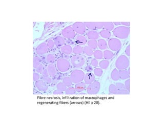 Fibre necrosis, infiltration of macrophages and
regenerating fibers (arrows) (HE x 20).
 