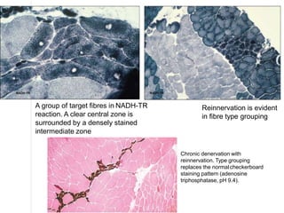 Reinnervation is evident
in fibre type grouping
A group of target fibres in NADH-TR
reaction. A clear central zone is
surrounded by a densely stained
intermediate zone
Chronic denervation with
reinnervation. Type grouping
replaces the normalcheckerboard
staining pattern (adenosine
triphosphatase, pH 9.4).
 